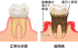 正常な状態、歯周病